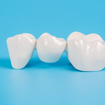 Top 10 Dental Bridges FAQ